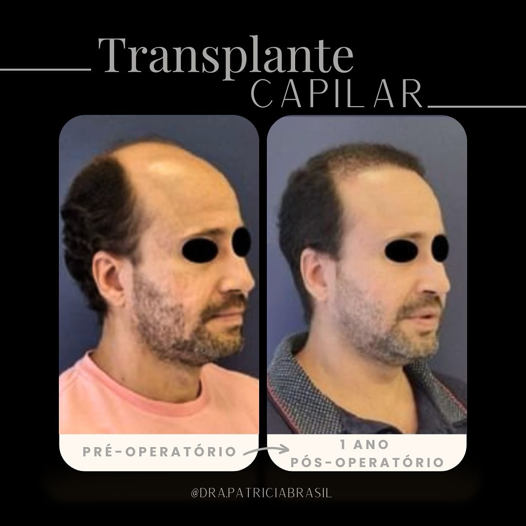 Antes x depois patricia